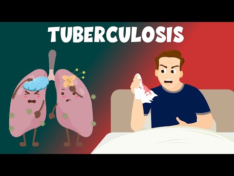 Tuberculosis: Causes, Symptoms, Diagnosis & Treatment – Learning Junction